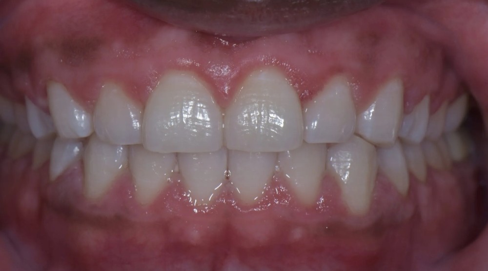 After image